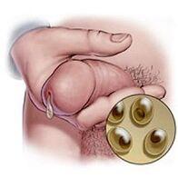 Décharge à Chlamydia